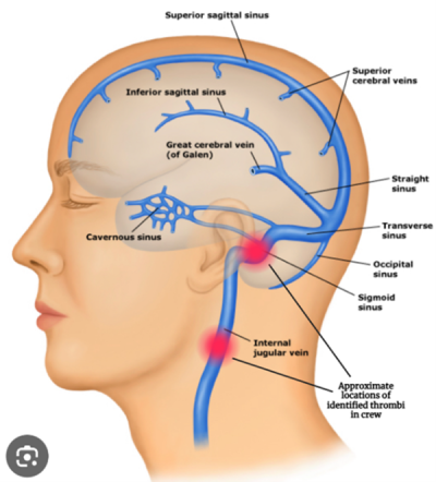 Approximate location of identified thrombi in crewmembers.