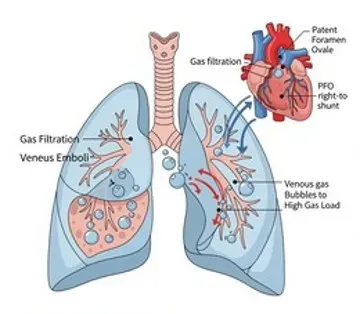 Uzay Uçuşunda Dekompresyon Hastalığı ve Venöz Tromboembolizm Riski ile Patent Foramen Ovale Etkileri