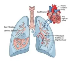 Uzay Uçuşunda Dekompresyon Hastalığı ve Venöz Tromboembolizm Riski ile Patent Foramen Ovale Etkileri